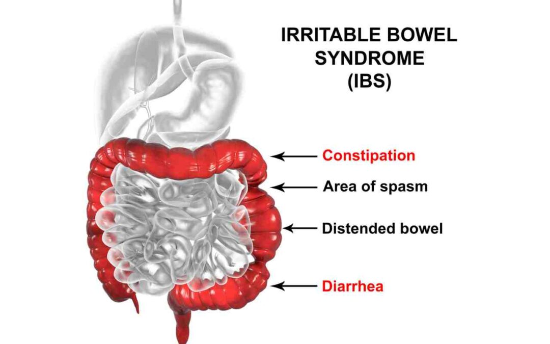 irritable bowel syndrome (IBS)
