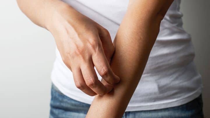 Intestinal fungus causes eczema and itchy skin irritation