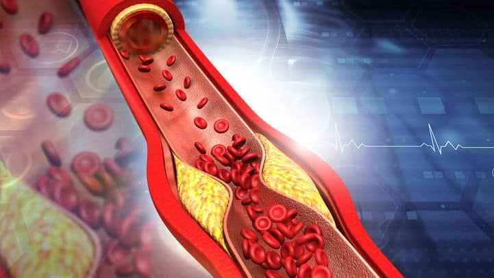 arteriosclerosis