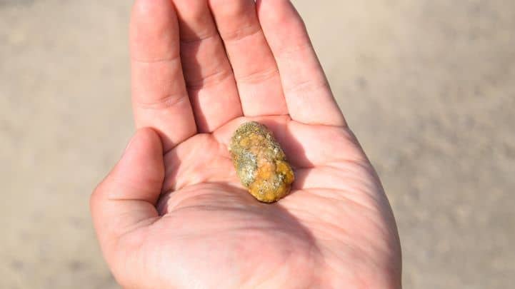 How to prevent gallstones