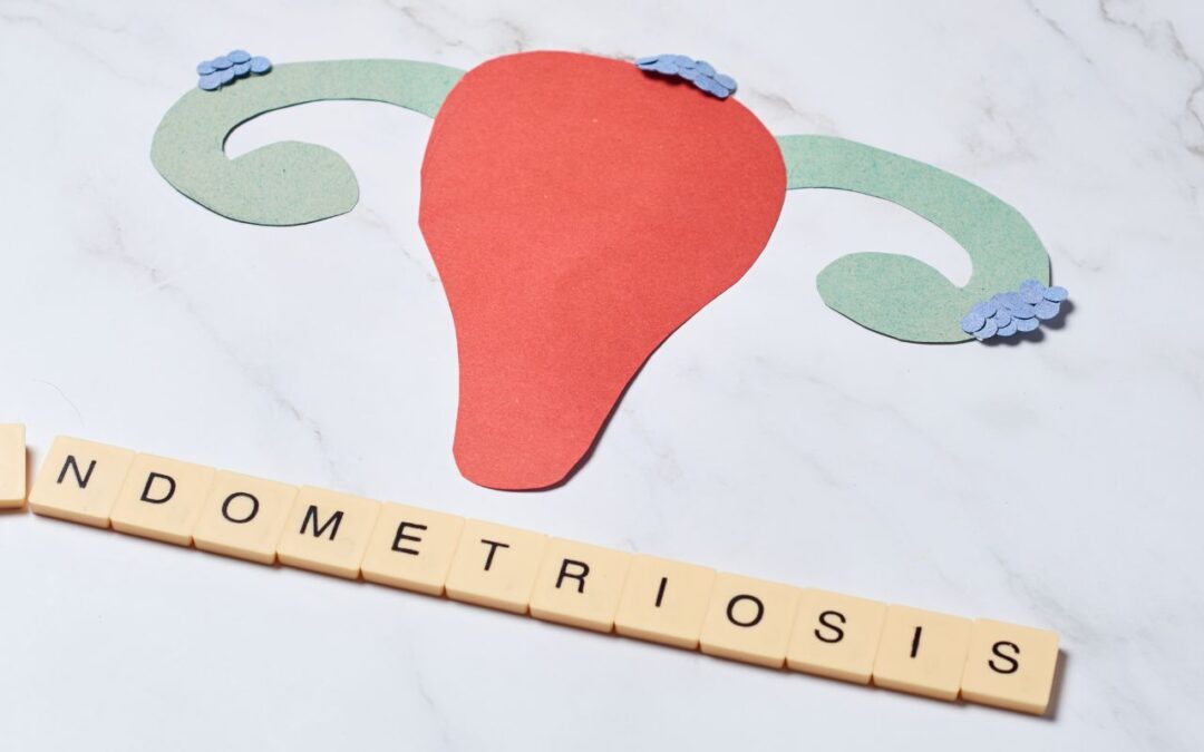 Understanding Endometriosis: Causes, Diet, and Natural Remedies