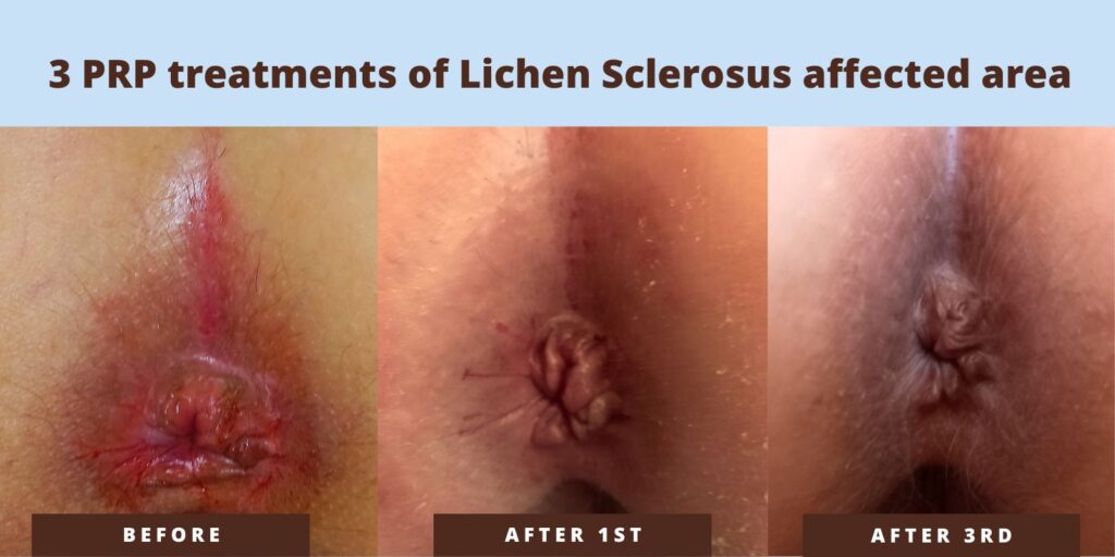 Lichen Sclerosis PRP treatment