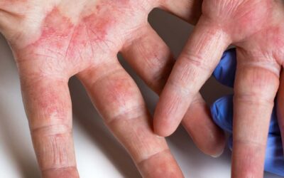 Atopic Dermatitis