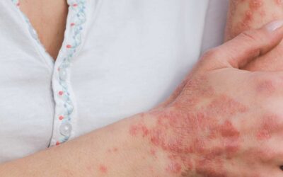 Prevention and Treatment of Skin Diseases