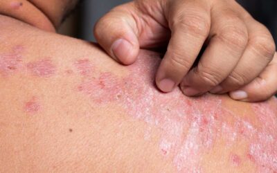 Relieve Psoriasis Naturally